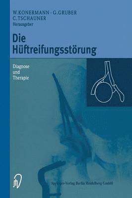 Die Hüftreifungsstörung