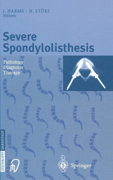J. Harms, H. Sturtz, J. Harms, H. Stürz - Severe Spondylolisthesis: Pathology - Diagnosis - Therapy, Inbunden