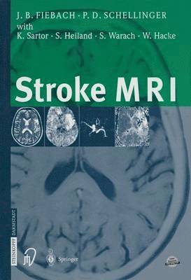 Stroke MRI 1