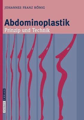 bokomslag Abdominoplastik