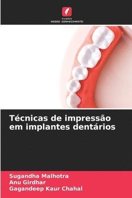 Sugandha Malhotra, Anu Girdhar, Gagandeep Kaur Chahal - Técnicas de impressão em implantes dentários, Häftad