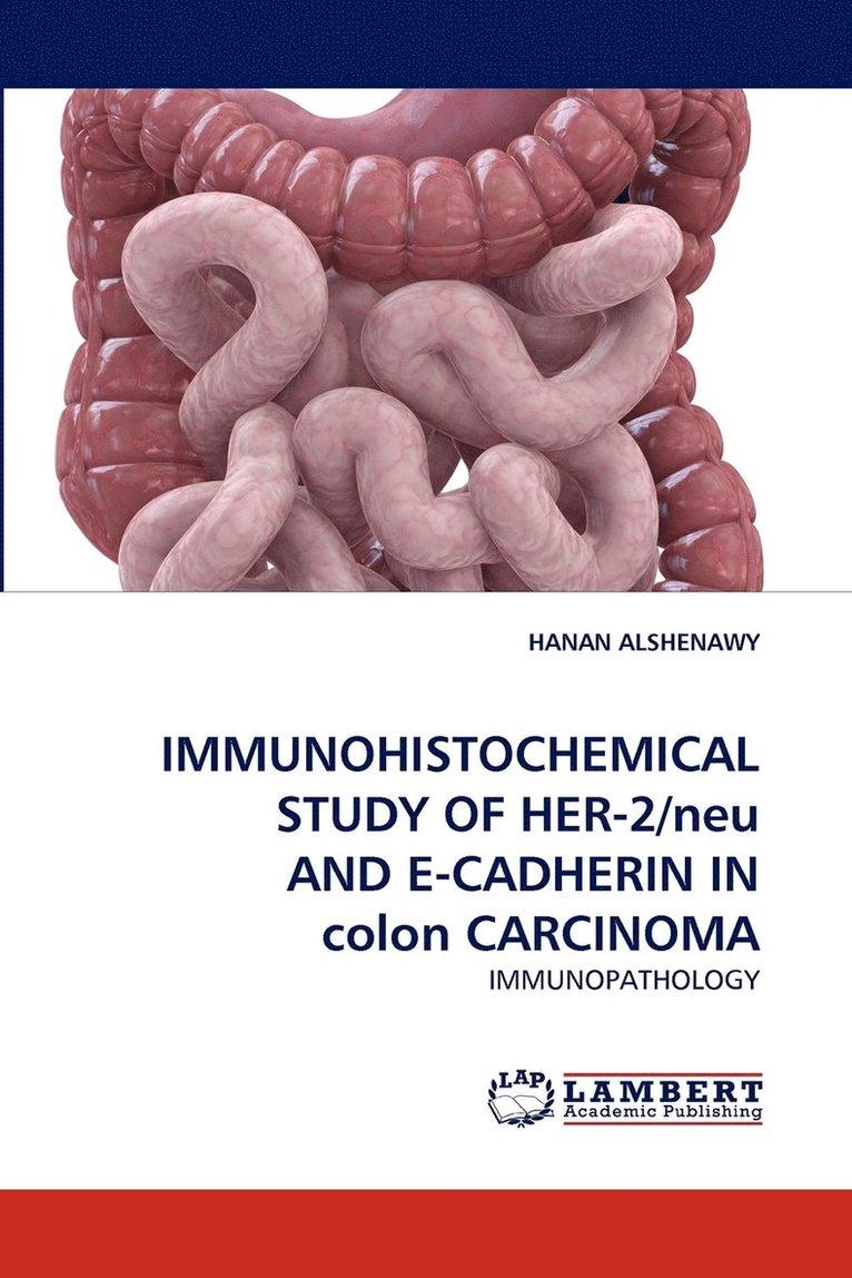 IMMUNOHISTOCHEMICAL STUDY OF HER-2/neu AND E-CADHERIN IN colon CARCINOMA 1