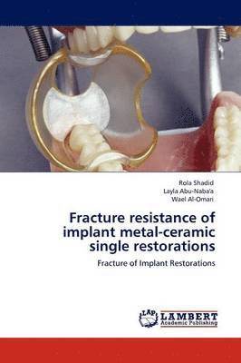 Fracture Resistance of Implant Metal-Ceramic Single Restorations 1