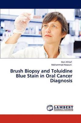 Brush Biopsy and Toluidine Blue Stain in Oral Cancer Diagnosis 1