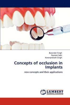 Concepts of occlusion in Implants 1