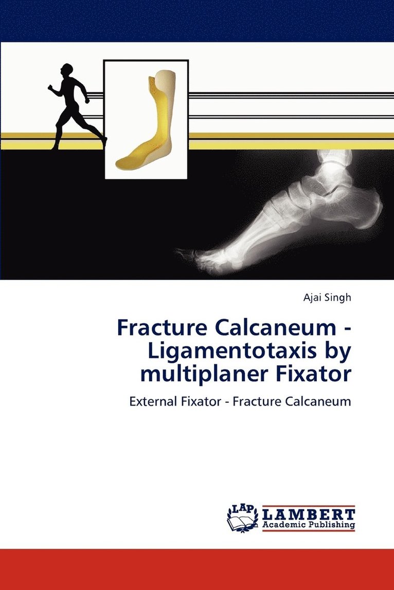 Fracture Calcaneum - Ligamentotaxis by multiplaner Fixator 1