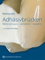 Adhäsivbrücken 1