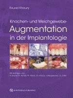 Knochen- und Weichgewebeaugmentation in der Implantologie 1