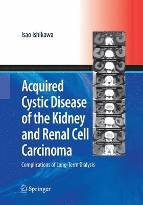 bokomslag Acquired Cystic Disease of the Kidney and Renal Cell Carcinoma