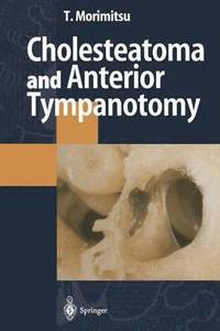 bokomslag Cholesteatoma and Anterior Tympanotomy