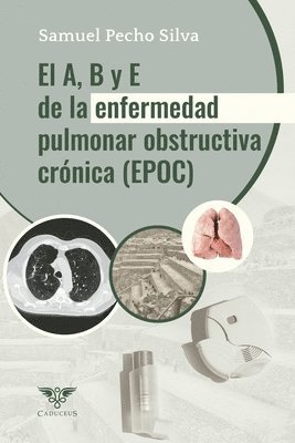 Kovy Arteaga Livias, Ana Claudia Navarro Solsol, José Alberto Pineda Bonilla - A, B y E de la Enfermedad Pulmonar Obstructiva Crónica (EPOC), Häftad