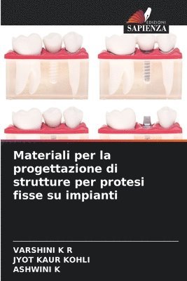 Materiali per la progettazione di strutture per protesi fisse su impianti