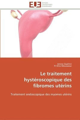 bokomslag traitement hystéroscopique des fibromes utérins