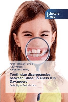 Tooth size discrepancies between Class I & Class II in Davangere 1