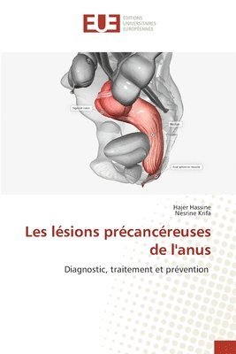 Les lésions précancéreuses de l'anus