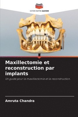 Maxillectomie et reconstruction par implants