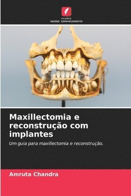 Amruta Chandra - Maxillectomia e reconstrução com implantes, Häftad