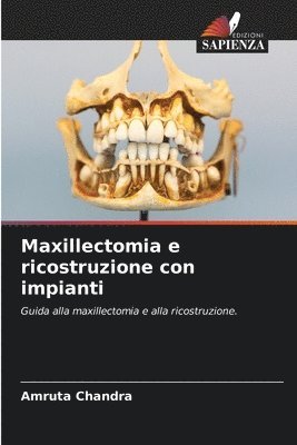 Maxillectomia e ricostruzione con impianti 1