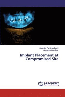 Implant Placement at Compromised Site 1