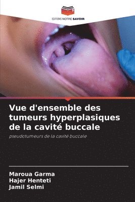 bokomslag Vue d'ensemble des tumeurs hyperplasiques de la cavité buccale
