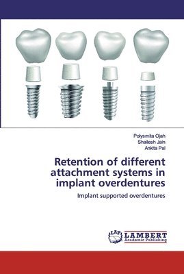 Retention of different attachment systems in implant overdentures 1