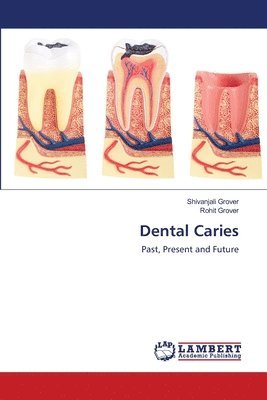 Dental Caries 1