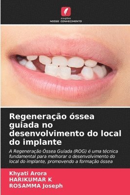 Khyati Arora, Harikumar K, Rosamma Joseph, HARIKUMAR K - Regeneração óssea guiada no desenvolvimento do local do implante, Häftad