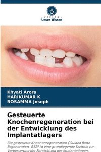 bokomslag Gesteuerte Knochenregeneration bei der Entwicklung des Implantatlagers