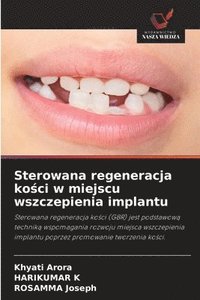 bokomslag Sterowana regeneracja ko?ci w miejscu wszczepienia implantu