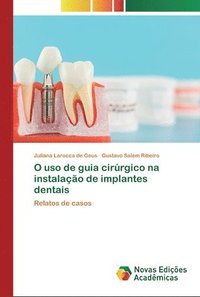 bokomslag O uso de guia cirrgico na instalao de implantes dentais