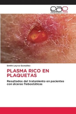 Plasma Rico En Plaquetas 1