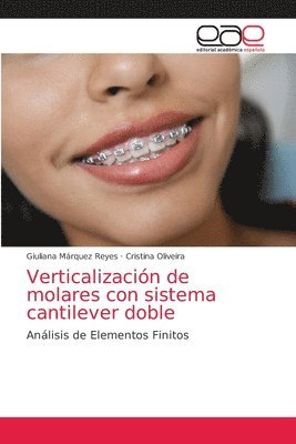 Verticalizacion de molares con sistema cantilever doble 1