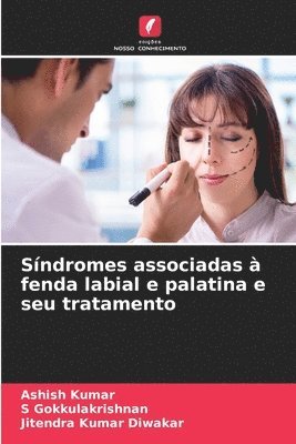 bokomslag Síndromes associadas à fenda labial e palatina e seu tratamento