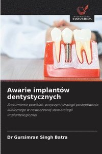 bokomslag Awarie implantów dentystycznych