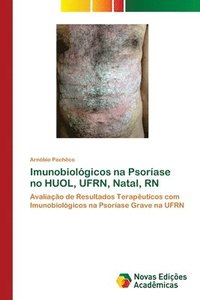 bokomslag Imunobiolgicos na Psorase no HUOL, UFRN, Natal, RN