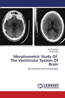 Morphometric Study Of The Ventricular System Of Brain 1