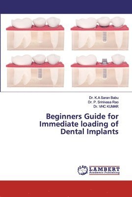 Beginners Guide for Immediate loading of Dental Implants 1
