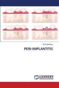 bokomslag Peri-Implantitis
