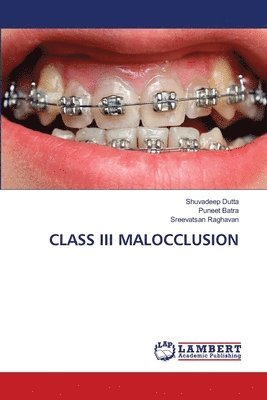 Class III Malocclusion 1