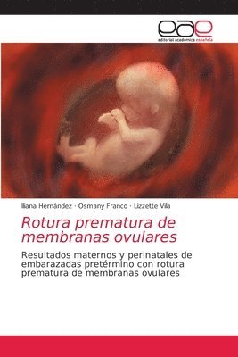 Rotura prematura de membranas ovulares 1