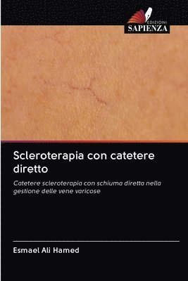 Scleroterapia con catetere diretto 1