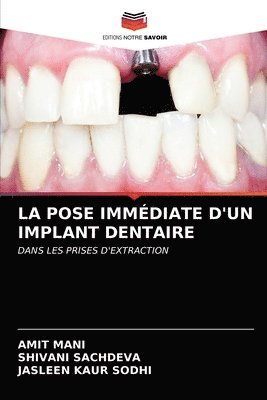 La Pose Immediate d'Un Implant Dentaire 1
