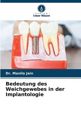 Bedeutung des Weichgewebes in der Implantologie 1