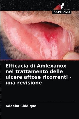 bokomslag Efficacia di Amlexanox nel trattamento delle ulcere aftose ricorrenti - una revisione