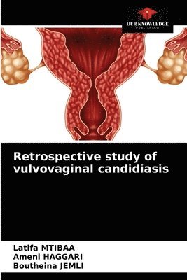 Retrospective study of vulvovaginal candidiasis 1