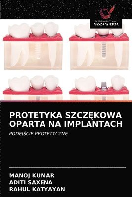 Manoj Kumar, Aditi Saxena, Rahul Katyayan - Protetyka SzczĘkowa Oparta Na Implantach, Häftad