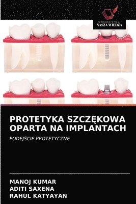 Protetyka Szcz&#280;kowa Oparta Na Implantach 1