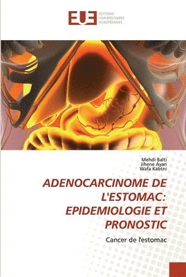 Adenocarcinome de l'Estomac 1