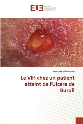 Le VIH chez un patient atteint de l'Ulcre de Buruli 1
