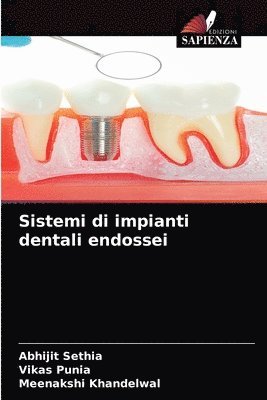 Sistemi di impianti dentali endossei 1